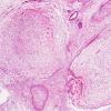 5A4 Neurofibroma, plexiform (Case 5) H&E 4