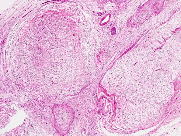 5A4 Neurofibroma, plexiform (Case 5) H&E 4