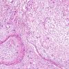 5A5 Neurofibroma, plexiform (Case 5) H&E 3