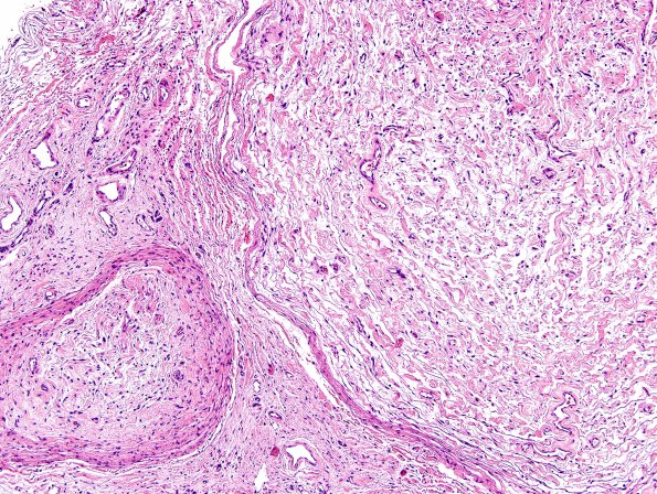 5A5 Neurofibroma, plexiform (Case 5) H&E 3