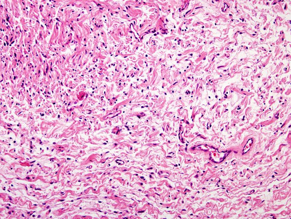 5A6 Neurofibroma, plexiform (Case 5) H&E 2