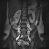 6A Neurofibroma, plexiform (NF1) (Case 6) T2 STIR - Copy - Copy