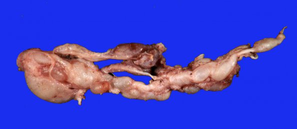 6B1 Neurofibroma, plexiform (NF1) (Case 6) Gross_1