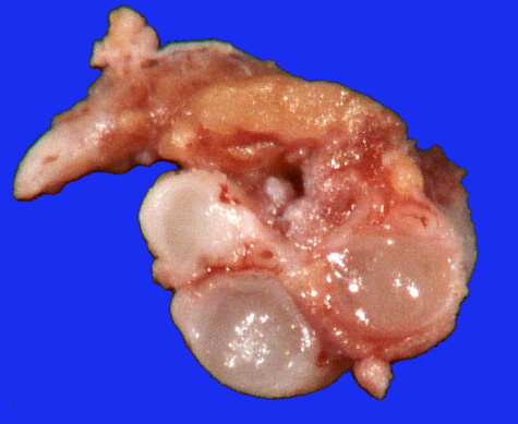 6B3 Neurofibroma, plexiform (NF1) (Case 6) Gross_4