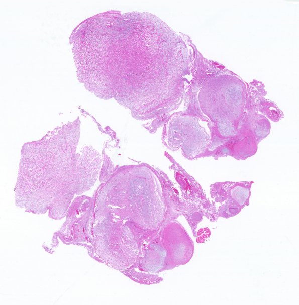 6C1 Neurofibroma, plexiform (NF1) (Case 6) H&E whole mount