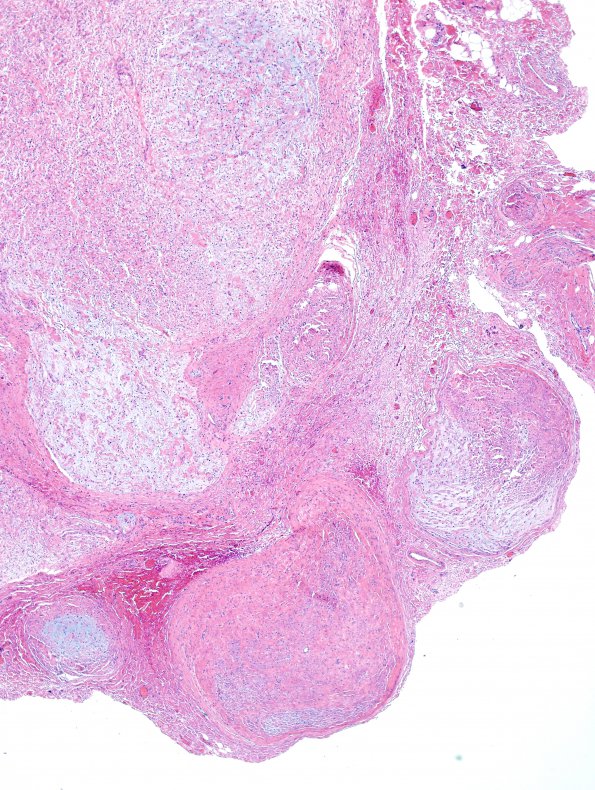 6C2 Neurofibroma, plexiform (NF1) (Case 6) H&E 3