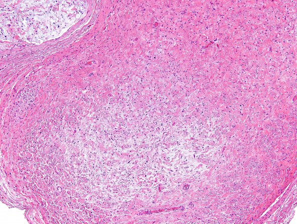 6C4 Neurofibroma, plexiform (NF1) (Case 6) H&E 5