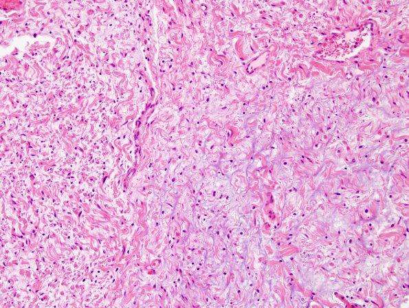 6C5 Neurofibroma, plexiform (NF1) (Case 6) H&E 2