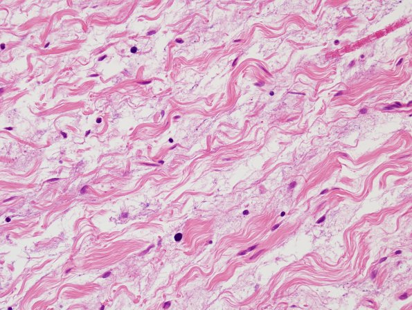 6C6 Neurofibroma, plexiform (NF1) (Case 6) H&E 1