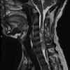 7A Neurofibromas in NF1 patient (Case 7) T2 3 - Copy