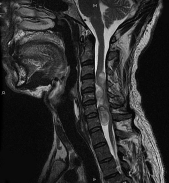 7A Neurofibromas in NF1 patient (Case 7) T2 3 - Copy