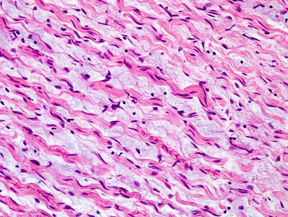 7B2 Neurofibroma in NF1 patient (Case 7) H&E 10.jpg