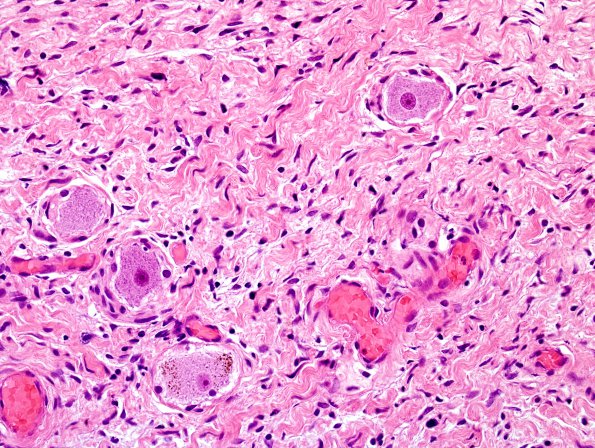 7B3 Neurofibroma in NF1 patient (Case 7) H&E 1.jpg