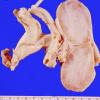 8A Neurofibroma (Case 8A) femoral nerve gross 1