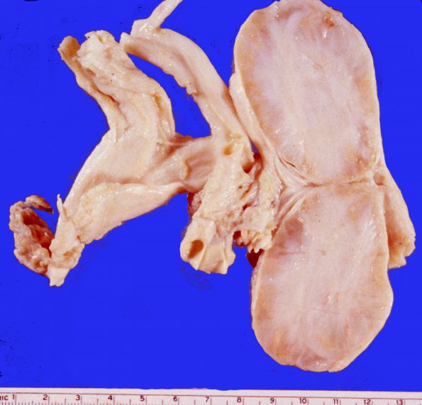 8A Neurofibroma (Case 8A) femoral nerve gross 1