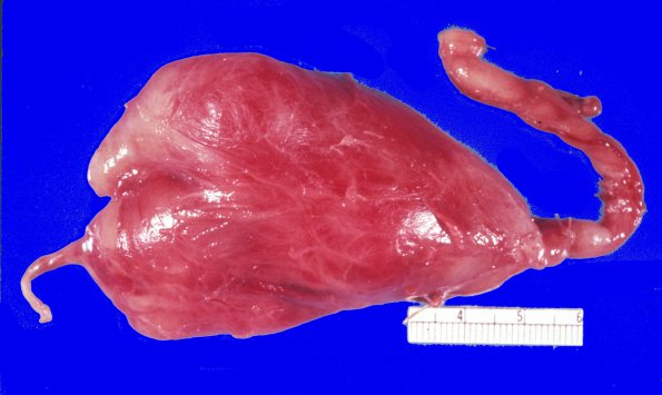 8F1 Neurofibroma, vagus nerve 1 (Case 8F)