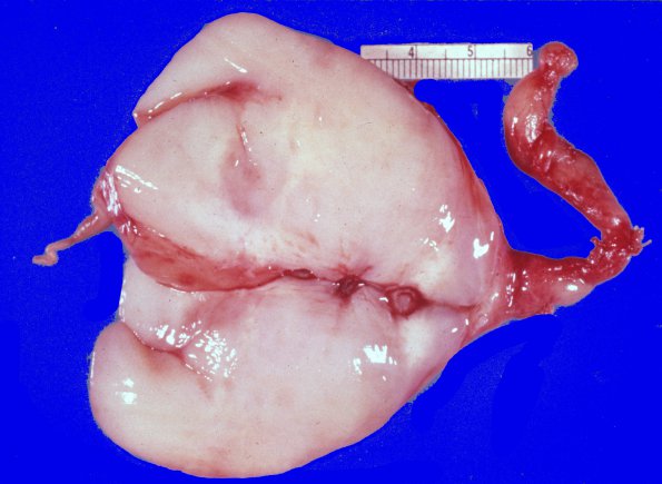 8F2 Neurofibroma, vagus nerve 1 (Case 8F)