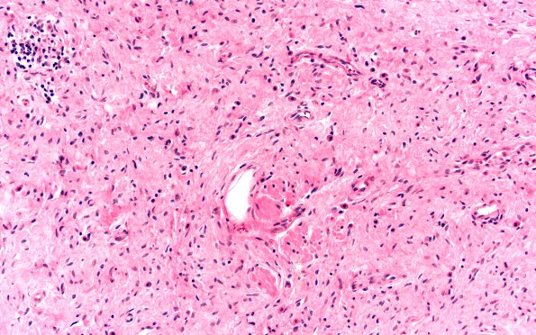 9A Neurofibroma, cutaneous (Case 9) H&E 20X