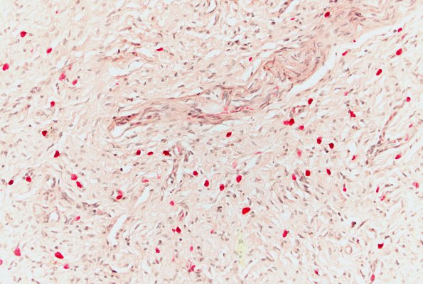 9A2 Neurofibroma, cutaneous (Case 9) Leder stain 20X