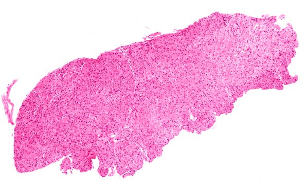 10A1 Perineurioma, intraneural (Case 10) H&E 3