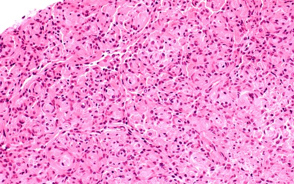 10A2 Perineurioma, intraneural (Case 10) H&E 1