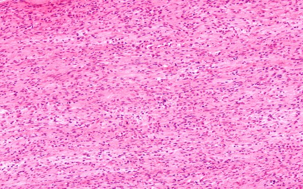 10A3 Perineurioma, intraneural (Case 10) H&E 4