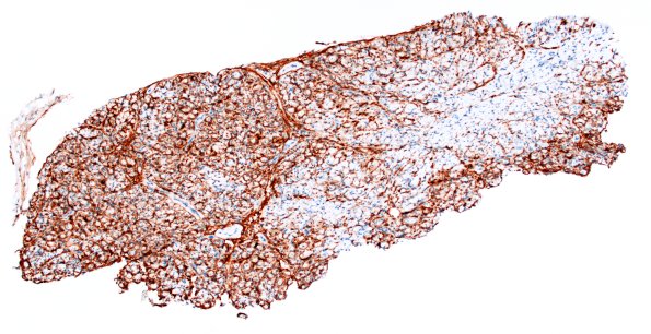 10B1 Perineurioma, intraneural (Case 10) EMA 4