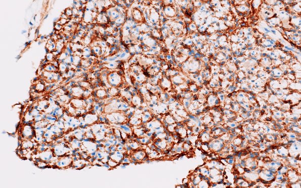 10B2 Perineurioma, intraneural (Case 10) EMA 5