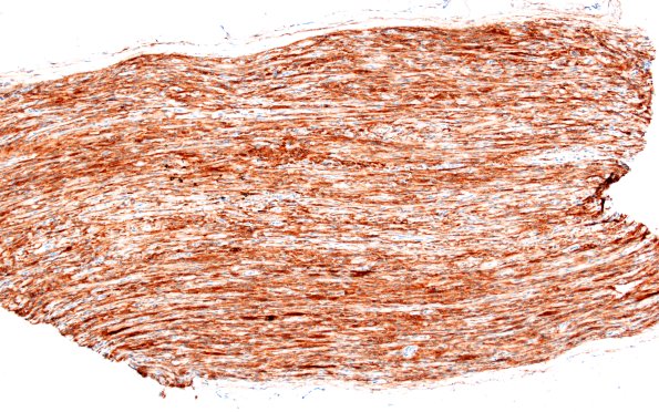 10B3 Perineurioma, intraneural (Case 10) EMA 10