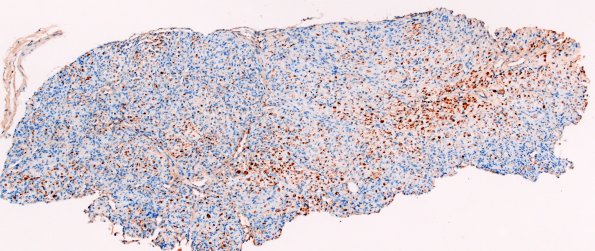 10C1 Perineurioma, intraneural (Case 10) S100 5