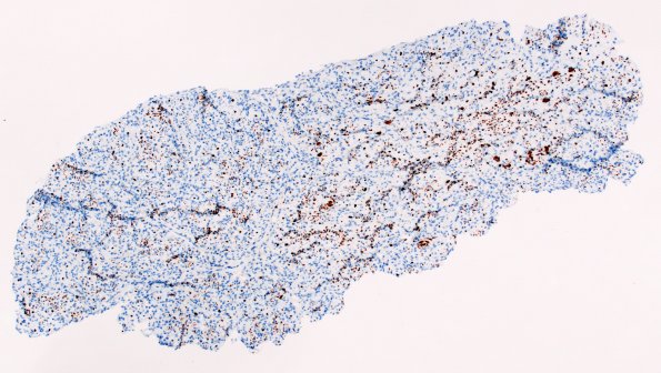 10D1 Perineurioma, intraneural (Case 10) NF 4