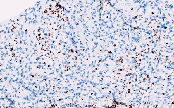 10D2 Perineurioma, intraneural (Case 10) NF 2