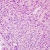 11A Perineurioma (Case 11) H&E 1