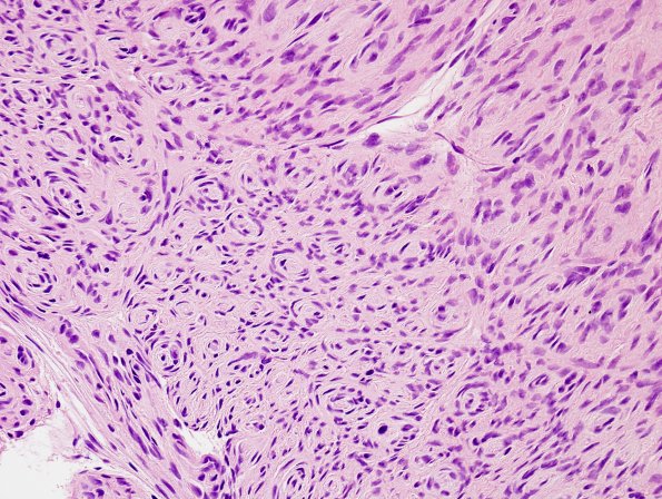 11A Perineurioma (Case 11) H&E 1