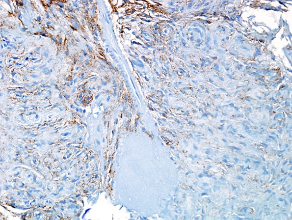 11B1 Perineurioma (Case 11) EMA 6