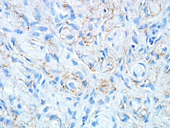 11B2 Perineurioma (Case 11) EMA 3