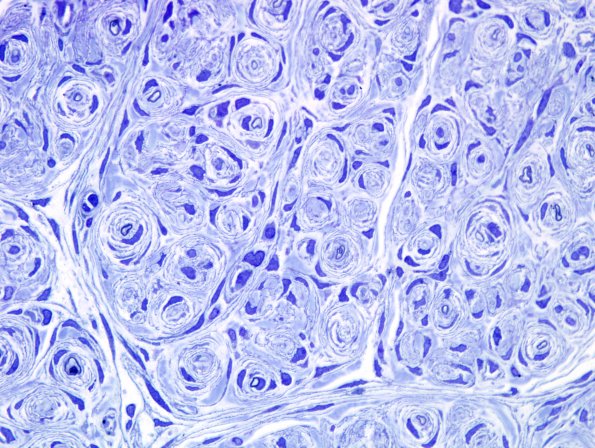 11D1 Perineurioma (Case 11) Plastic 3