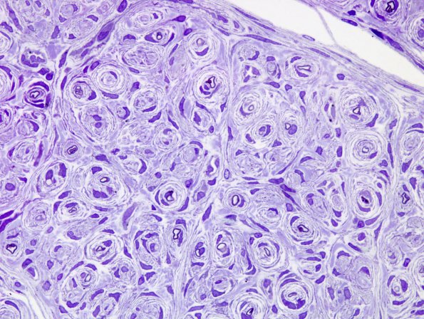 11D2 Perineurioma (Case 11) Plastic 5