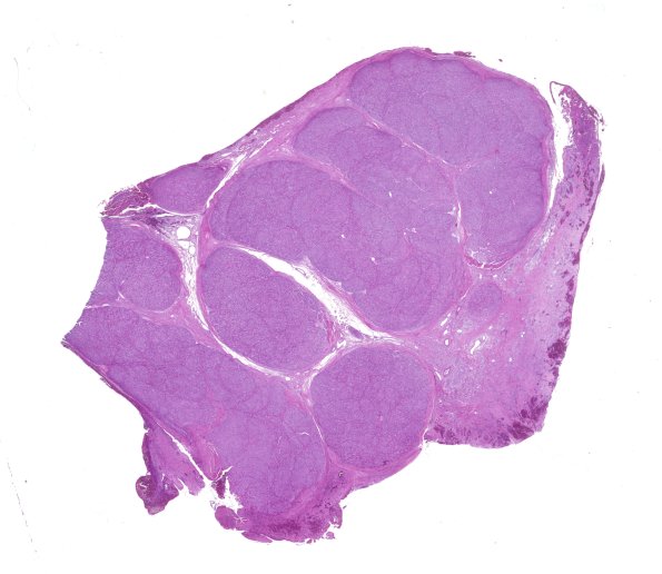 12A1 Perineurioma (Case 12) H&E whole mounta