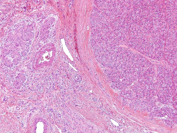 12A2 Perineurioma (Case 12) H&E 1.jpg