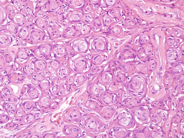 12A3 Perineurioma (Case 12) H&E 4.jpg