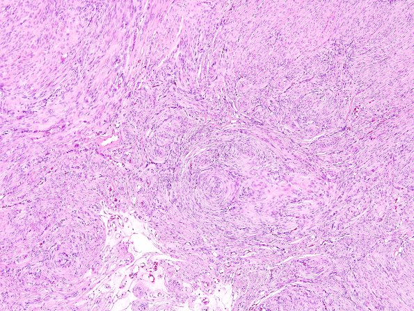 13A1 Perineurioma, soft tissue (NPExch 2004-Case 1) H&E 1