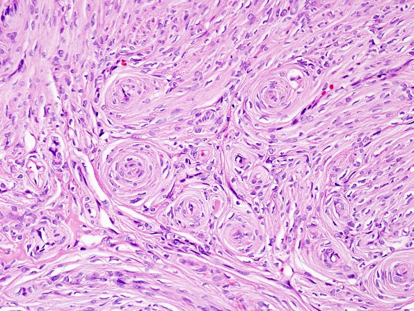 13A2 Perineurioma, soft tissue (NPExch 2004-Case 1) H&E 3