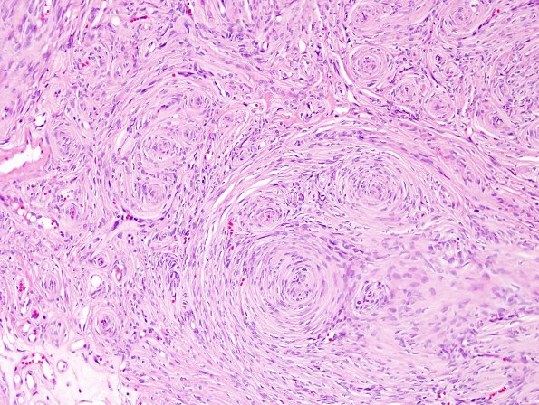 13A3 Perineurioma, soft tissue (NPExch 2004-Case 1) H&E 2