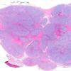 14A1 Perineurioma, plexiform (AANP 2008 Case 10) H&E whole mount