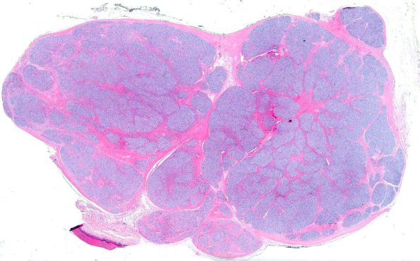 14A1 Perineurioma, plexiform (AANP 2008 Case 10) H&E whole mount