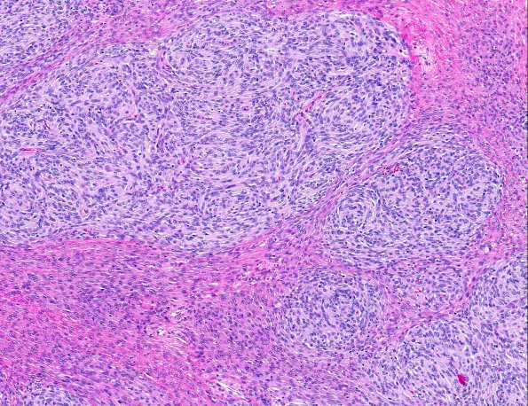 14A2 Perineurioma, plexiform (AANP 2008 Case 10) H&E 10X 2