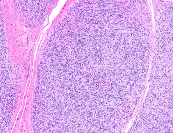 14A3 Perineurioma, plexiform (AANP 2008 Case 10) H&E 10X