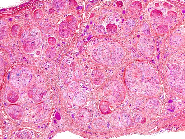 15A1 Perineurioma (Case 15) Pentachrome HPS 2.jpg