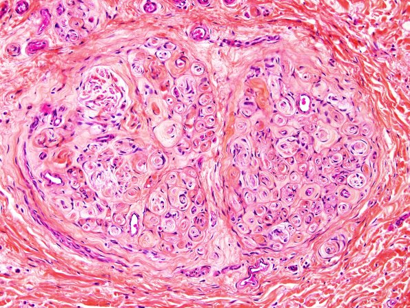 15A3 Perineurioma (Case 15) Pentachrome HPS 3.jpg